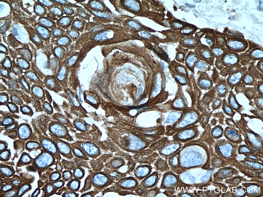 Immunohistochemistry (IHC) staining of human oesophagus cancer tissue using Cytokeratin 15 Monoclonal antibody (60247-1-Ig)