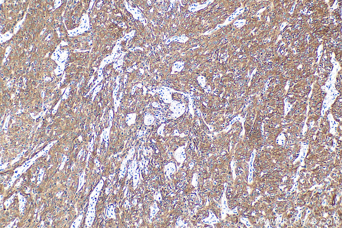 Immunohistochemical analysis of paraffin-embedded human cervical cancer tissue slide using 60247-1-Ig (Cytokeratin 15 antibody) at dilution of 1:4000 (under 10x lens). Heat mediated antigen retrieval with Tris-EDTA buffer (pH 9.0). Immunohistochemistry (IHC) staining of human cervical cancer tissue using Cytokeratin 15 Monoclonal antibody (60247-1-Ig)