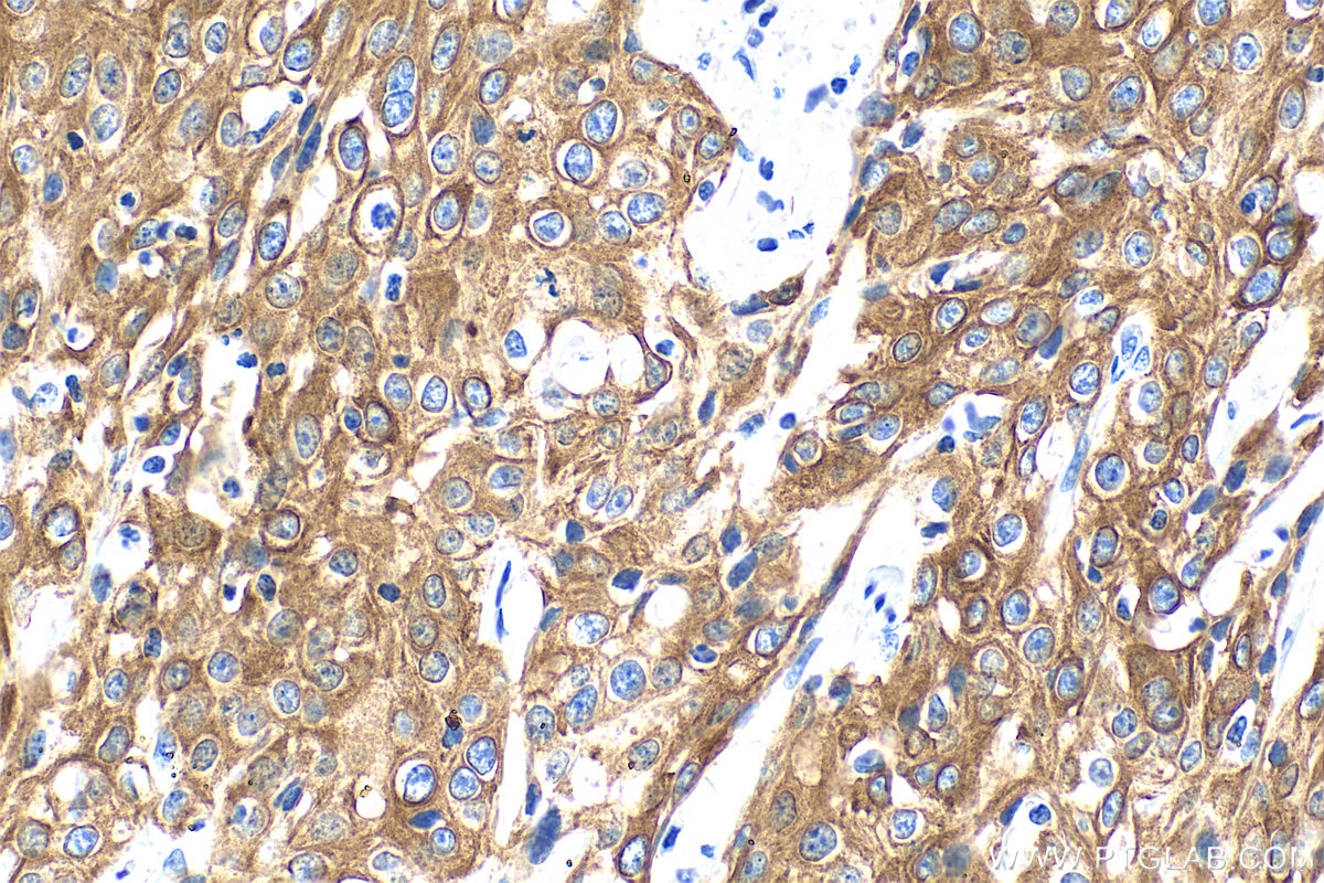 Immunohistochemical analysis of paraffin-embedded human cervical cancer tissue slide using 60247-1-Ig (Cytokeratin 15 antibody) at dilution of 1:4000 (under 40x lens). Heat mediated antigen retrieval with Tris-EDTA buffer (pH 9.0). Immunohistochemistry (IHC) staining of human cervical cancer tissue using Cytokeratin 15 Monoclonal antibody (60247-1-Ig)