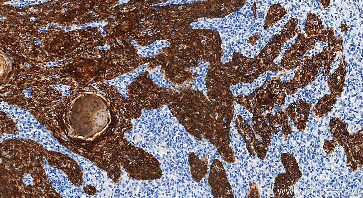 Immunohistochemical analysis of paraffin-embedded human skin cancer tissue slide using 60247-1-Ig (Cytokeratin 15 antibody) at dilution of 1:4000 (under 20x lens). Heat mediated antigen retrieval with Tris-EDTA buffer (pH 9.0). Immunohistochemistry (IHC) staining of human skin cancer tissue using Cytokeratin 15 Monoclonal antibody (60247-1-Ig)