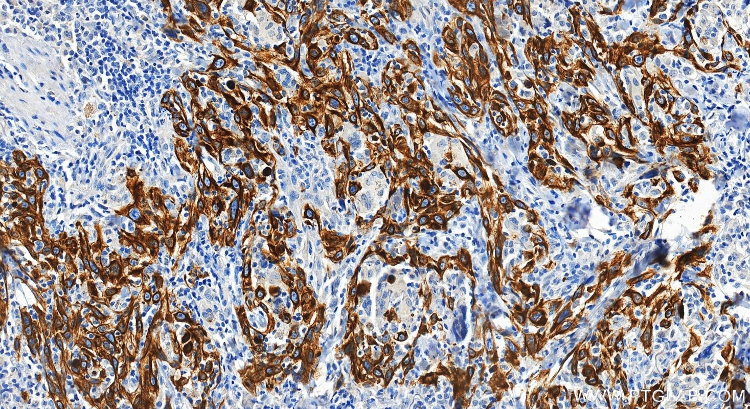 Immunohistochemical analysis of paraffin-embedded human skin cancer tissue slide using 60247-1-Ig (Cytokeratin 15 antibody) at dilution of 1:4000 (under 20x lens). Heat mediated antigen retrieval with Tris-EDTA buffer (pH 9.0). Immunohistochemistry (IHC) staining of human skin cancer tissue using Cytokeratin 15 Monoclonal antibody (60247-1-Ig)