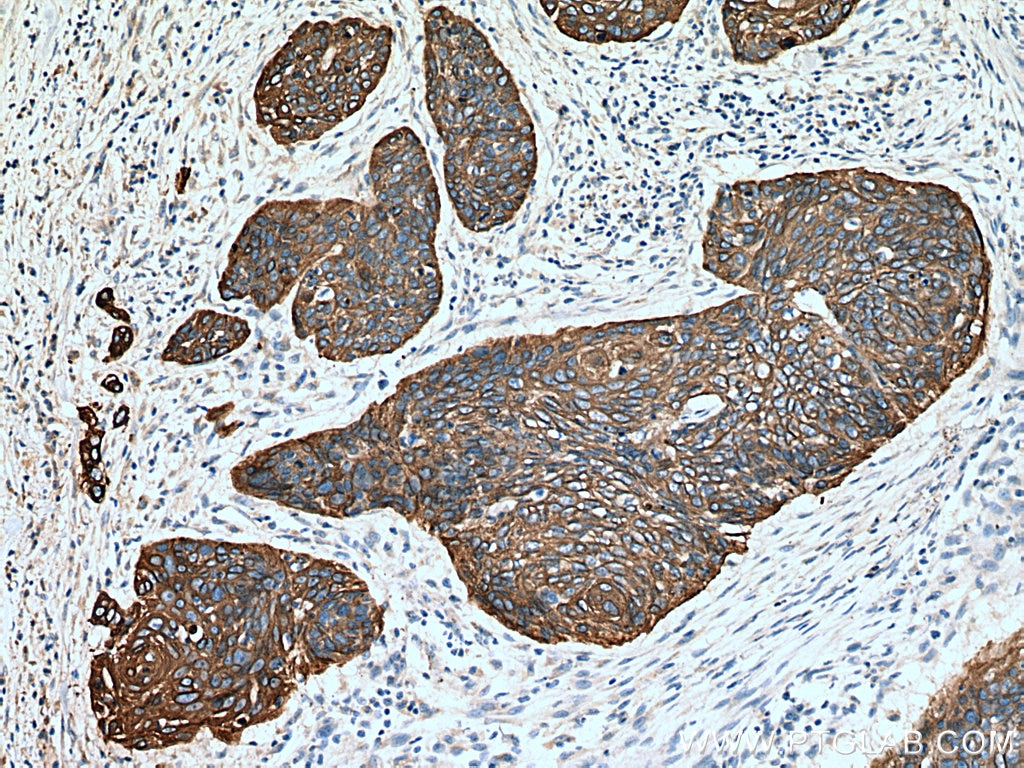 Immunohistochemistry (IHC) staining of human oesophagus cancer tissue using Cytokeratin 16 Polyclonal antibody (17265-1-AP)