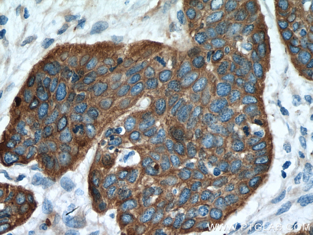 Immunohistochemistry (IHC) staining of human oesophagus cancer tissue using Cytokeratin 16 Polyclonal antibody (17265-1-AP)