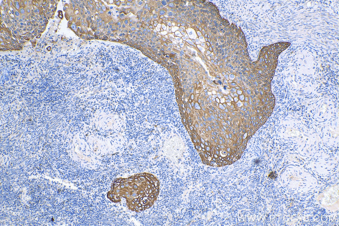 Immunohistochemistry (IHC) staining of human cervical cancer tissue using Cytokeratin 16 Polyclonal antibody (17265-1-AP)