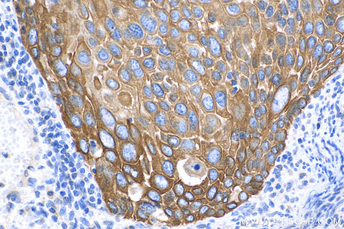 Immunohistochemistry (IHC) staining of human cervical cancer tissue using Cytokeratin 16 Polyclonal antibody (17265-1-AP)
