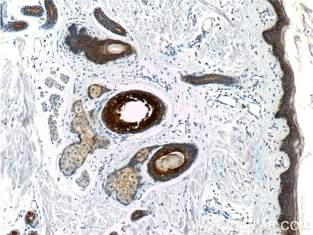 Immunohistochemistry (IHC) staining of human skin tissue using Cytokeratin 16 Polyclonal antibody (17265-1-AP)