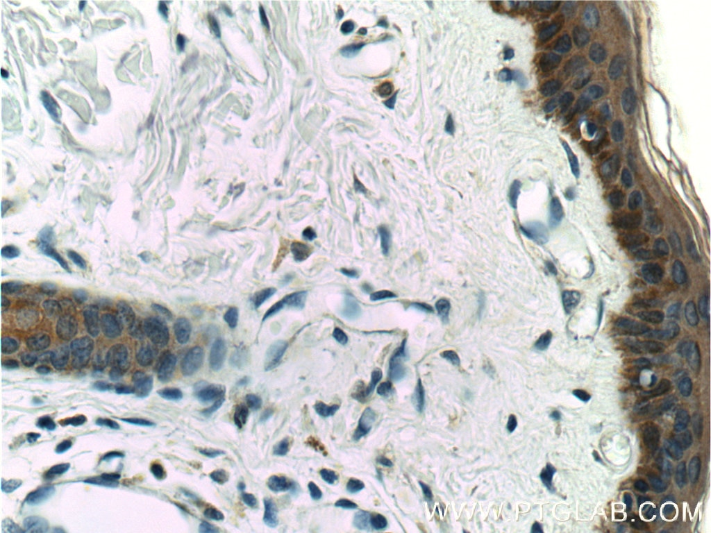Immunohistochemistry (IHC) staining of human skin tissue using Cytokeratin 16 Polyclonal antibody (17265-1-AP)