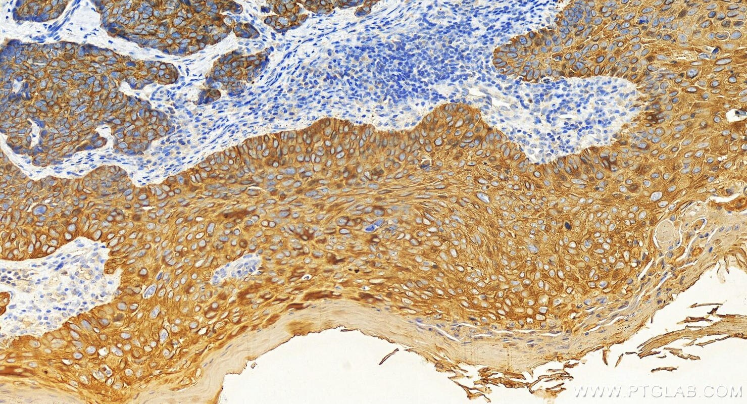 Immunohistochemistry (IHC) staining of human bowen disease using Cytokeratin 16 Polyclonal antibody (17265-1-AP)