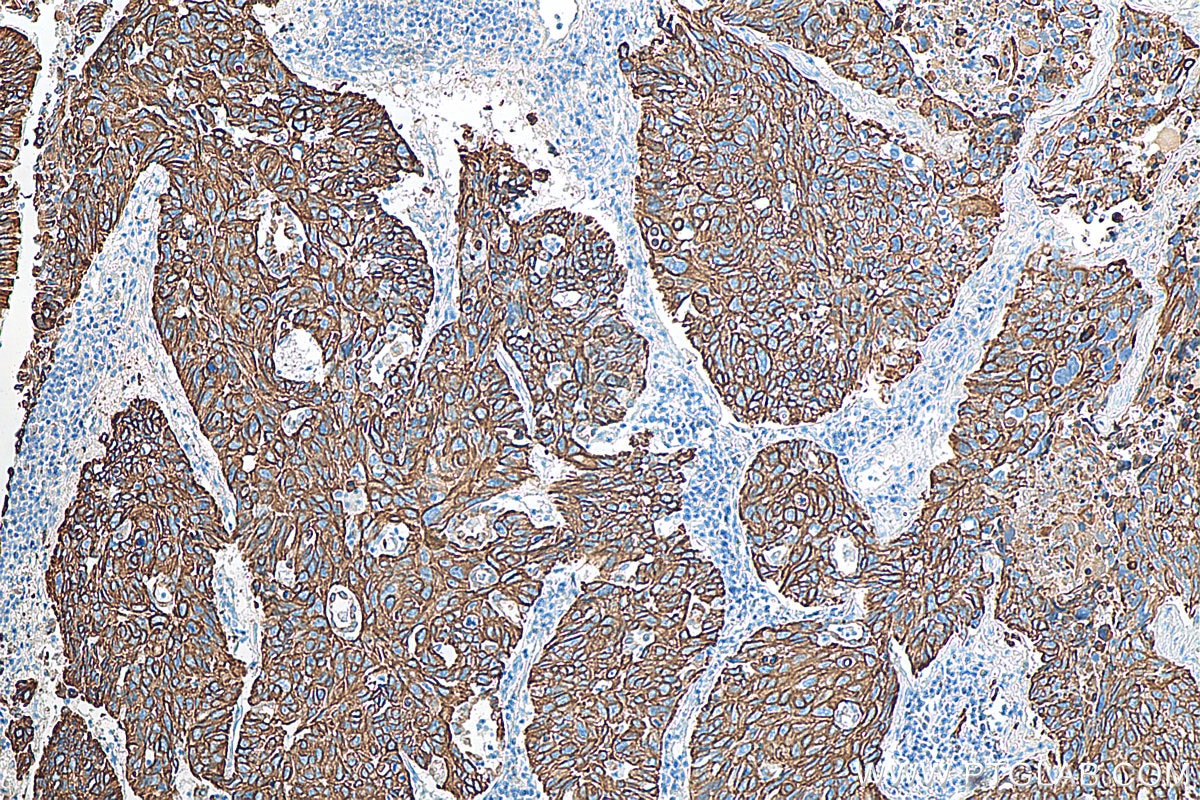 Immunohistochemistry (IHC) staining of human lung cancer tissue using Cytokeratin 17 Polyclonal antibody (18502-1-AP)