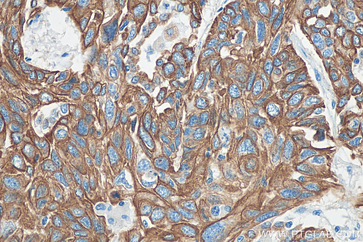 Immunohistochemistry (IHC) staining of human lung cancer tissue using Cytokeratin 17 Polyclonal antibody (18502-1-AP)