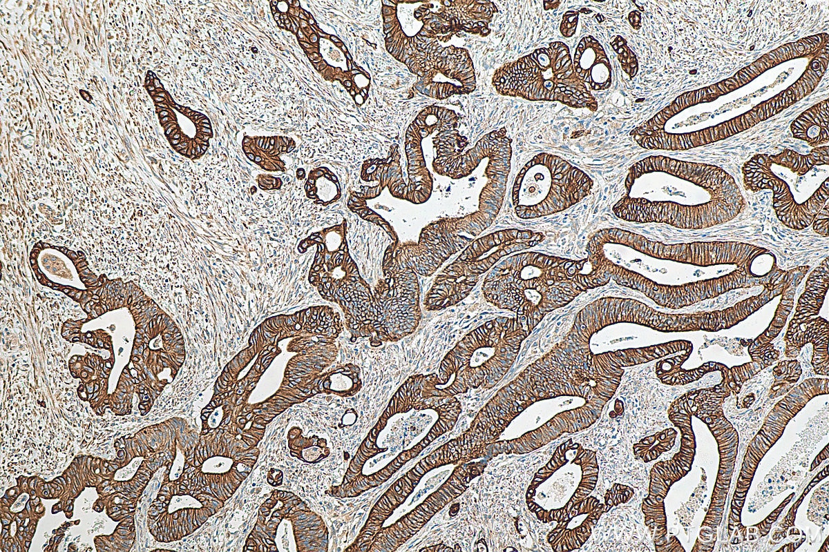 Immunohistochemistry (IHC) staining of human colon cancer tissue using Cytokeratin 17 Polyclonal antibody (18502-1-AP)