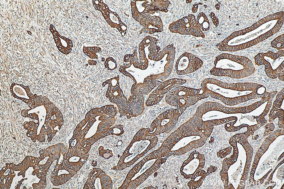 IHC staining of human colon cancer using 18502-1-AP