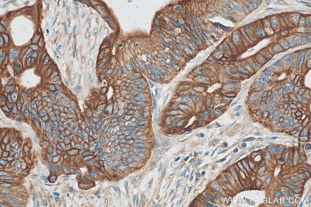 Immunohistochemistry (IHC) staining of human colon cancer tissue using Cytokeratin 17 Polyclonal antibody (18502-1-AP)