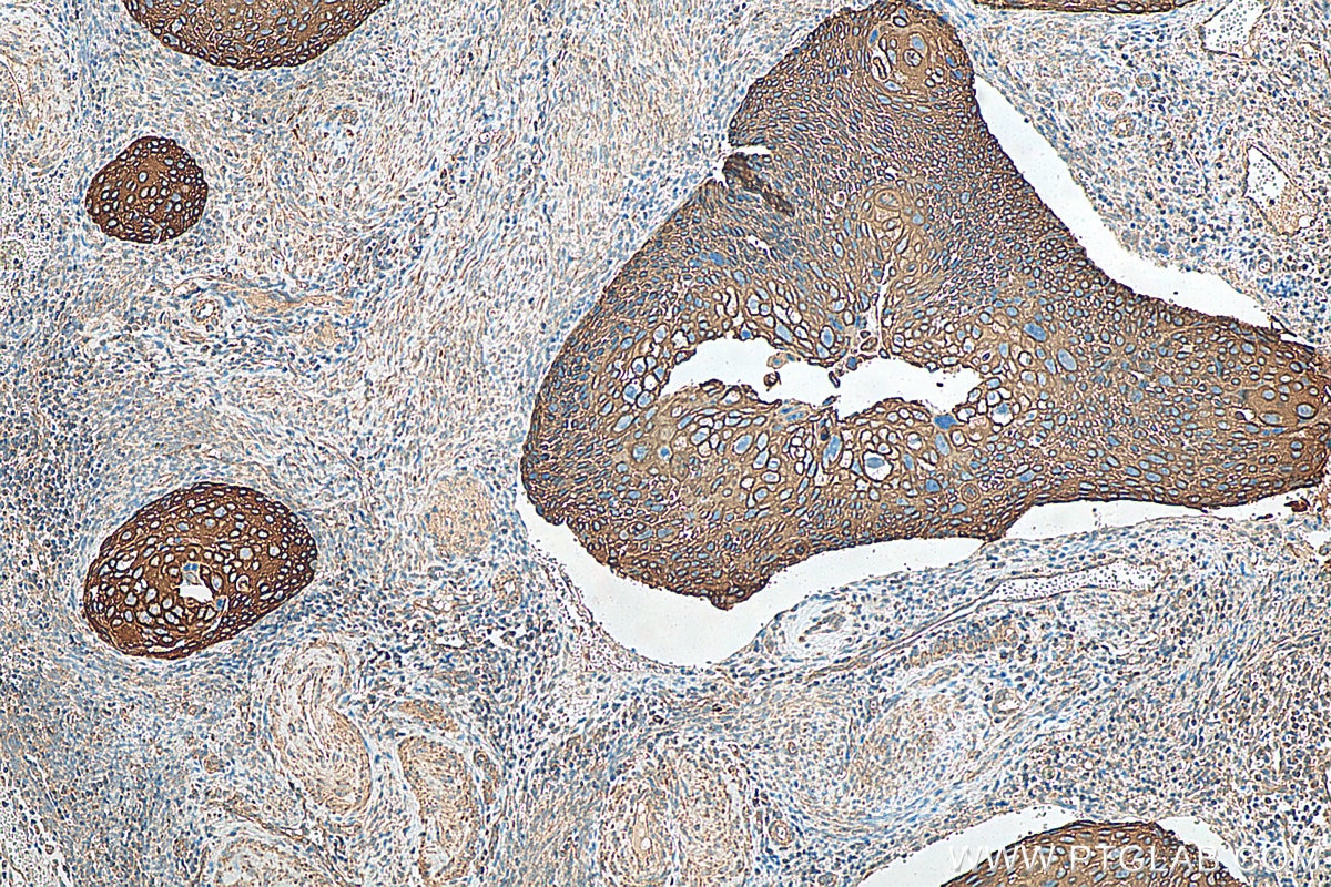 Immunohistochemistry (IHC) staining of human cervical cancer tissue using Cytokeratin 17 Polyclonal antibody (18502-1-AP)