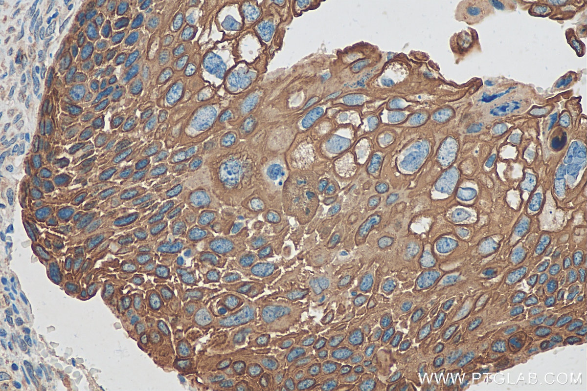 Immunohistochemistry (IHC) staining of human cervical cancer tissue using Cytokeratin 17 Polyclonal antibody (18502-1-AP)