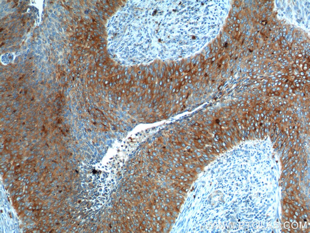 Immunohistochemistry (IHC) staining of human cervical cancer tissue using Cytokeratin 17 Polyclonal antibody (18502-1-AP)