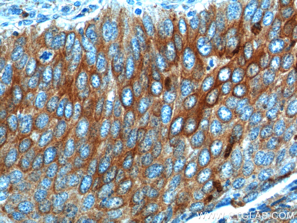 Immunohistochemistry (IHC) staining of human cervical cancer tissue using Cytokeratin 17 Polyclonal antibody (18502-1-AP)