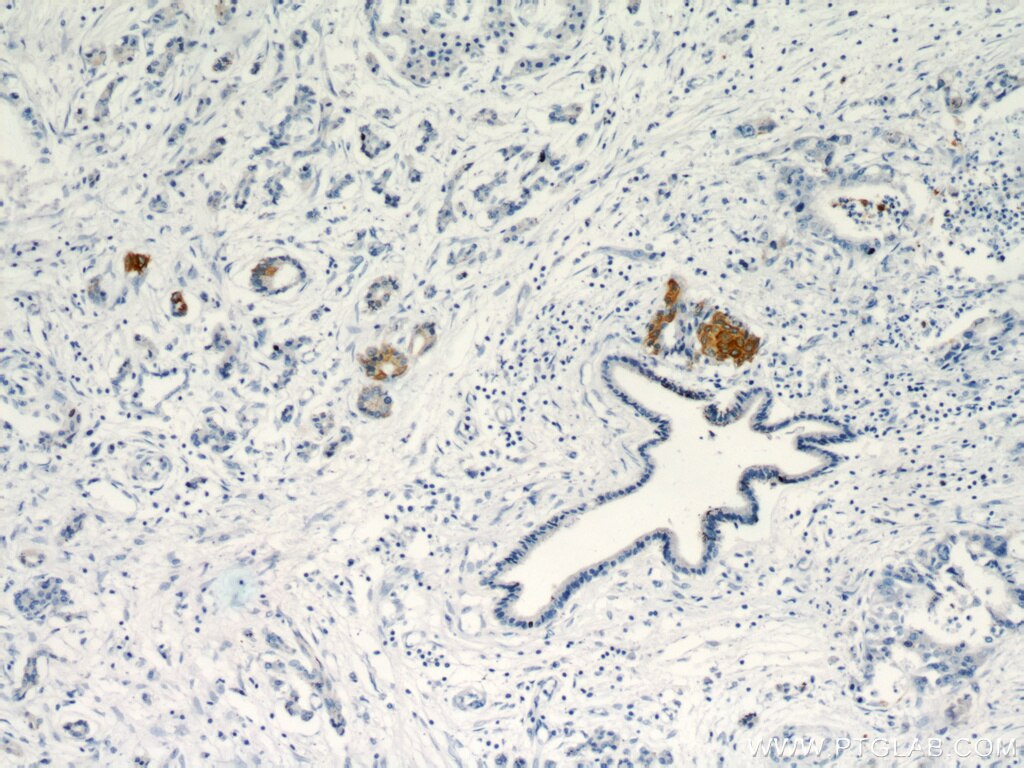 Immunohistochemistry (IHC) staining of human pancreas cancer tissue using Cytokeratin 17 Polyclonal antibody (18502-1-AP)