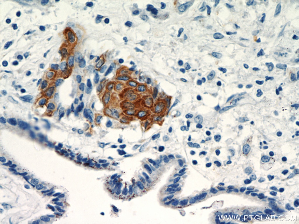 Immunohistochemistry (IHC) staining of human pancreas cancer tissue using Cytokeratin 17 Polyclonal antibody (18502-1-AP)
