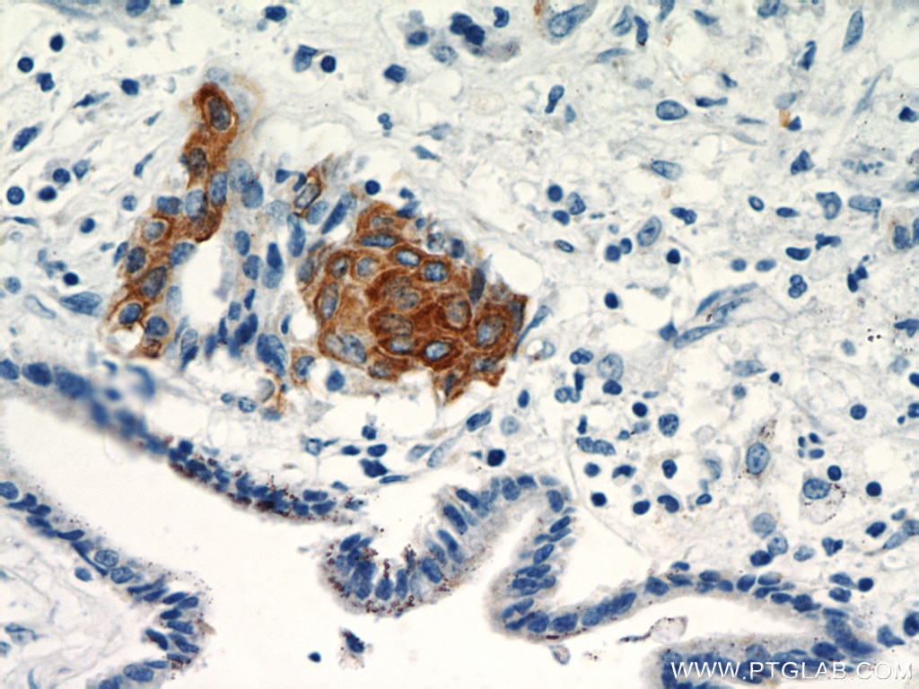 IHC staining of human pancreas cancer using 18502-1-AP