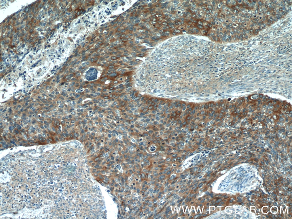 Immunohistochemistry (IHC) staining of human cervical cancer tissue using Cytokeratin 17 Polyclonal antibody (22230-1-AP)