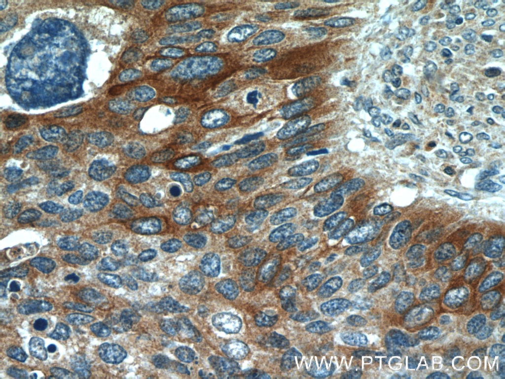 Immunohistochemistry (IHC) staining of human cervical cancer tissue using Cytokeratin 17 Polyclonal antibody (22230-1-AP)