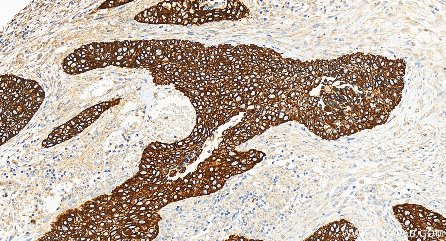 Immunohistochemistry (IHC) staining of human cervical cancer tissue using Cytokeratin 17-Specific Polyclonal antibody (17516-1-AP)