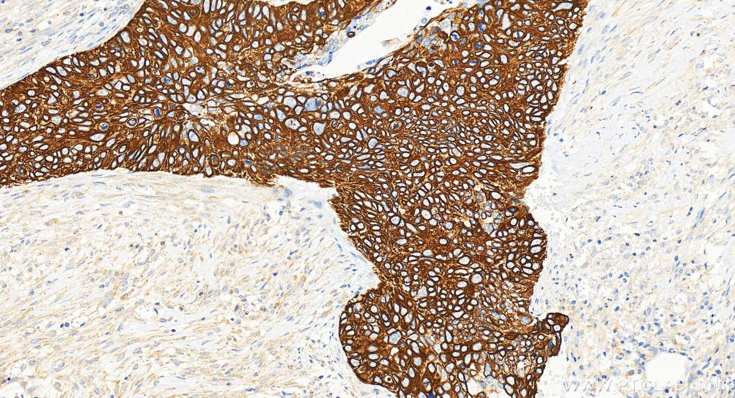 Immunohistochemistry (IHC) staining of human cervical cancer tissue using Cytokeratin 17-Specific Polyclonal antibody (17516-1-AP)