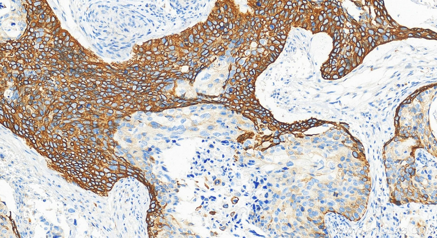 Immunohistochemistry (IHC) staining of human cervical squamous cancer tissue using Cytokeratin 17-Specific Polyclonal antibody (17516-1-AP)