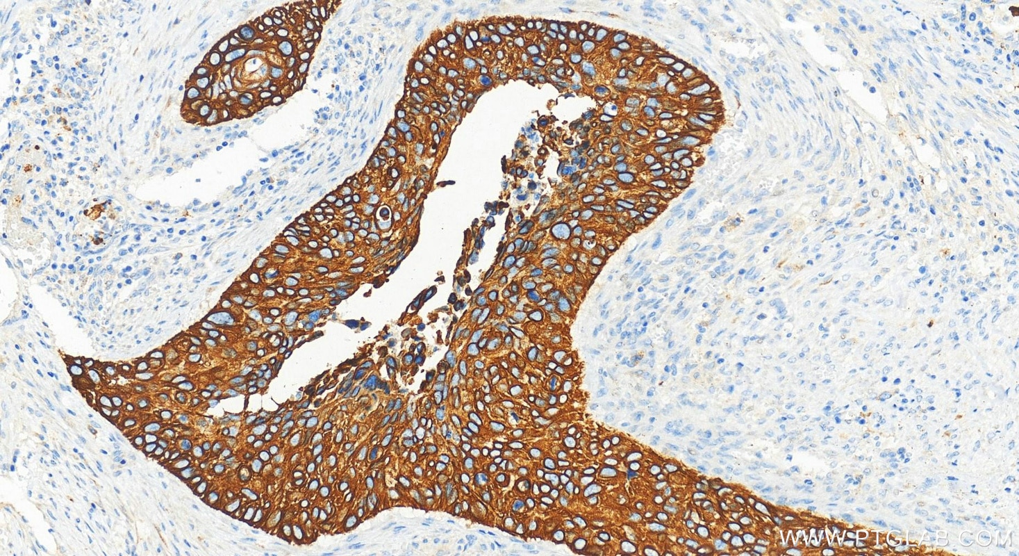 Immunohistochemistry (IHC) staining of human cervical squamous cancer tissue using Cytokeratin 17-Specific Polyclonal antibody (17516-1-AP)