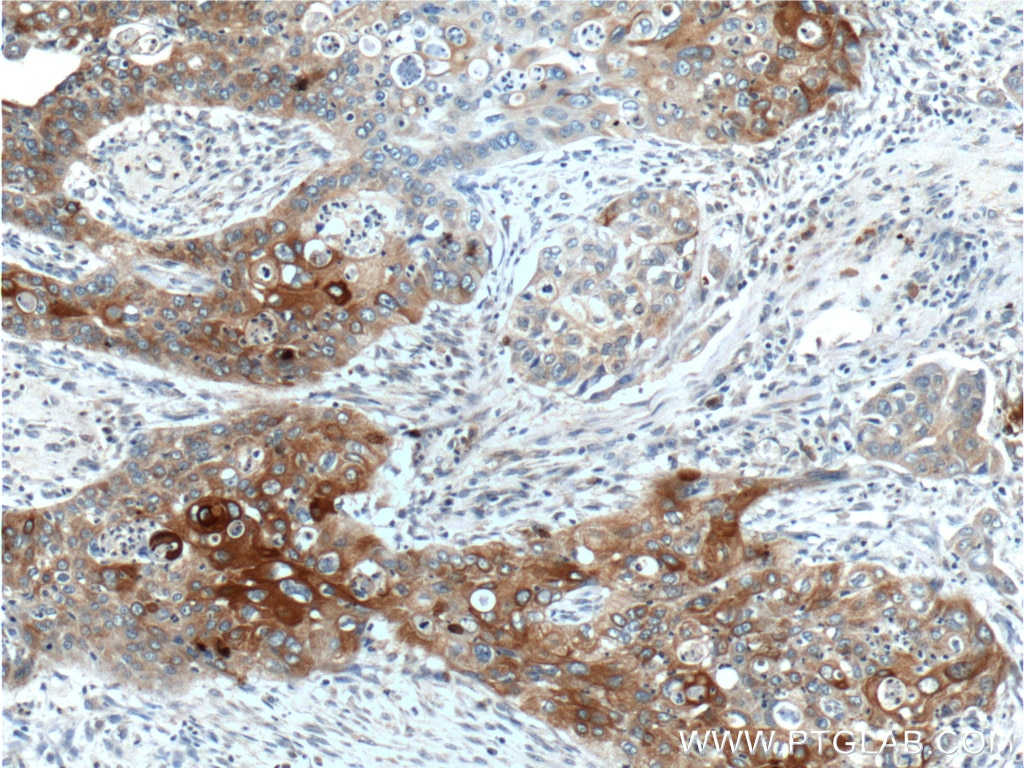 Immunohistochemistry (IHC) staining of human cervical cancer tissue using Cytokeratin 17-Specific Polyclonal antibody (17516-1-AP)