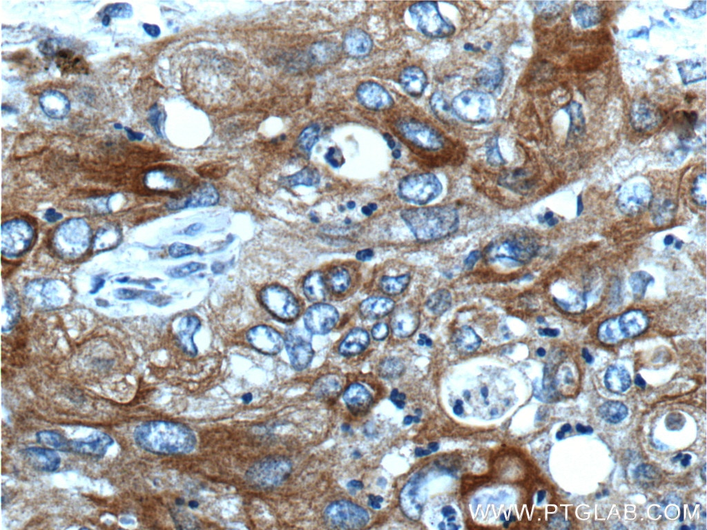 IHC staining of human cervical cancer using 17516-1-AP