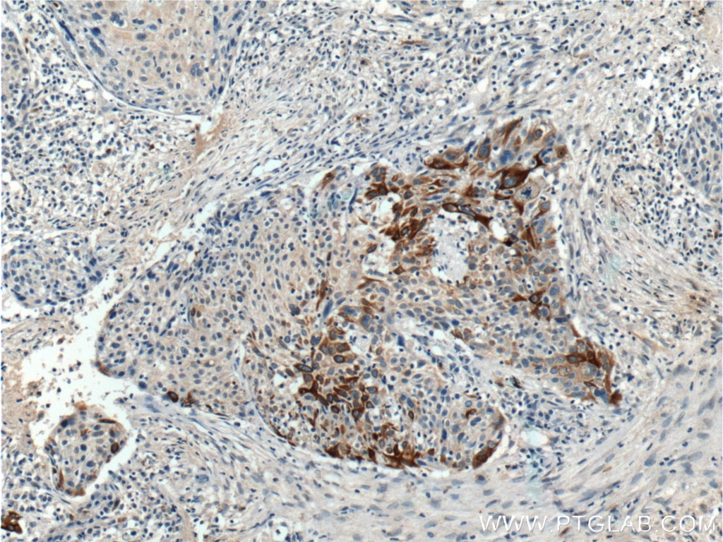 Immunohistochemistry (IHC) staining of human lung cancer tissue using Cytokeratin 17-Specific Polyclonal antibody (17516-1-AP)