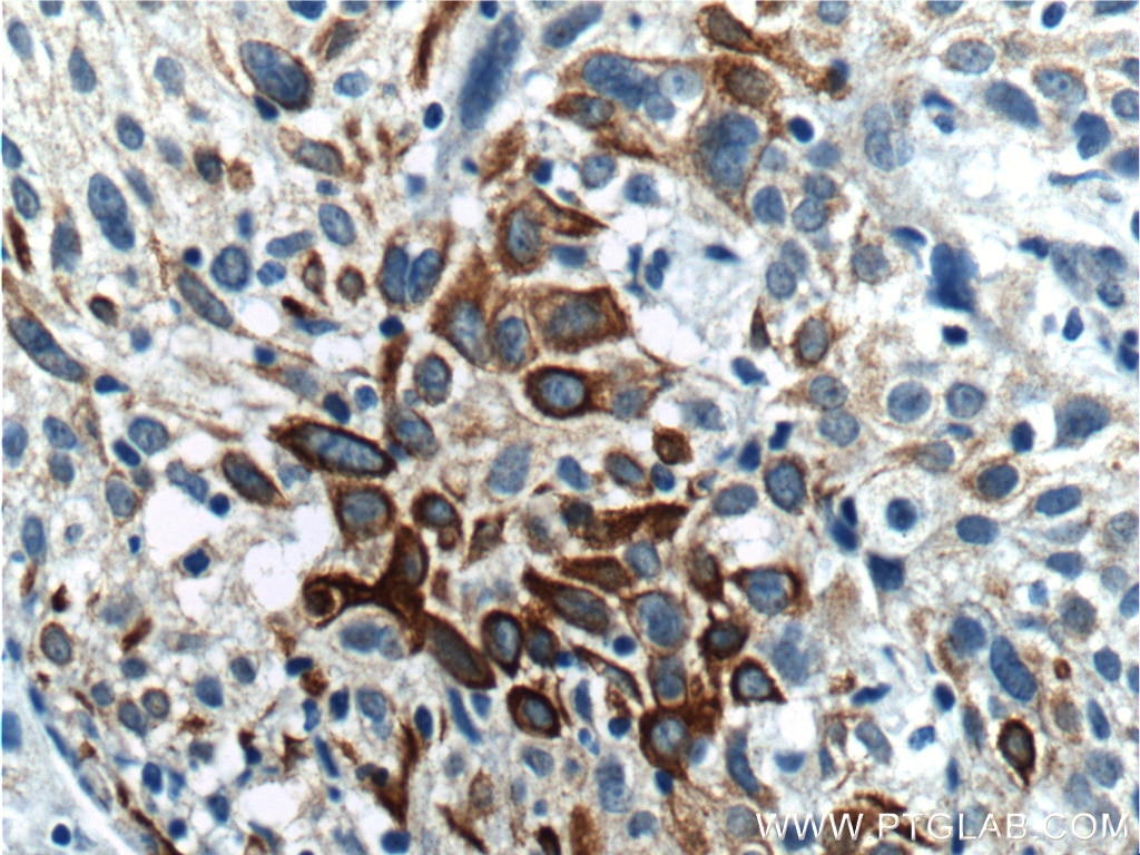 Immunohistochemistry (IHC) staining of human lung cancer tissue using Cytokeratin 17-Specific Polyclonal antibody (17516-1-AP)