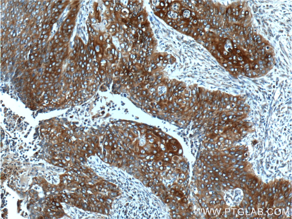 Immunohistochemistry (IHC) staining of human cervical cancer tissue using Cytokeratin 17-Specific Polyclonal antibody (17516-1-AP)