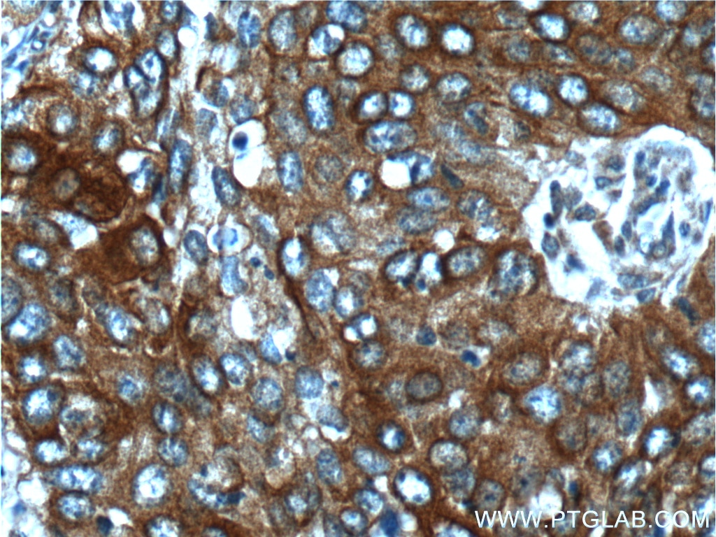 Immunohistochemistry (IHC) staining of human cervical cancer tissue using Cytokeratin 17-Specific Polyclonal antibody (17516-1-AP)