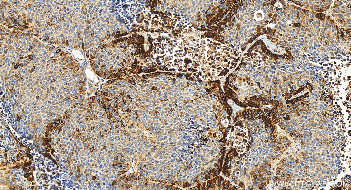 Immunohistochemistry (IHC) staining of human lung squamous cell carcinoma tissue using Cytokeratin 17-Specific Polyclonal antibody (17516-1-AP)