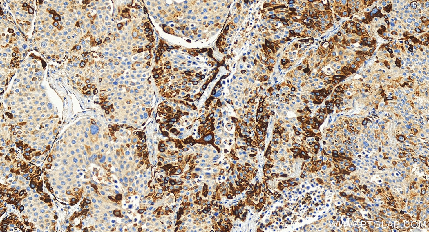 Immunohistochemistry (IHC) staining of human lung squamous cell carcinoma tissue using Cytokeratin 17-Specific Polyclonal antibody (17516-1-AP)