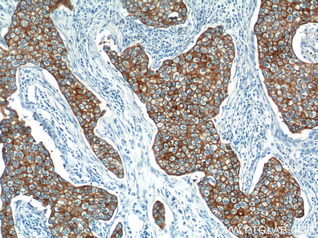 Immunohistochemistry (IHC) staining of human breast cancer tissue using Cytokeratin 18 Polyclonal antibody (10830-1-AP)