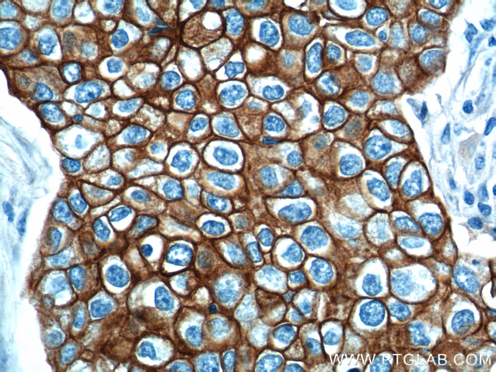 Immunohistochemistry (IHC) staining of human breast cancer tissue using Cytokeratin 18 Polyclonal antibody (10830-1-AP)