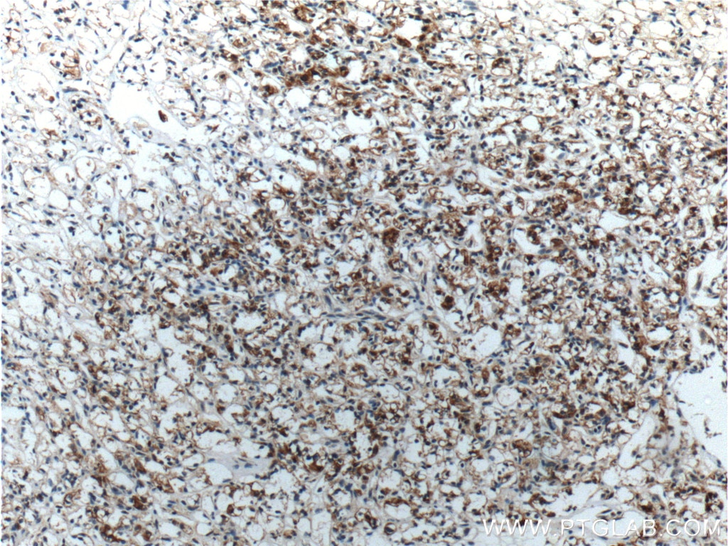 Immunohistochemistry (IHC) staining of human renal cell carcinoma tissue using Cytokeratin 18 Polyclonal antibody (10830-1-AP)