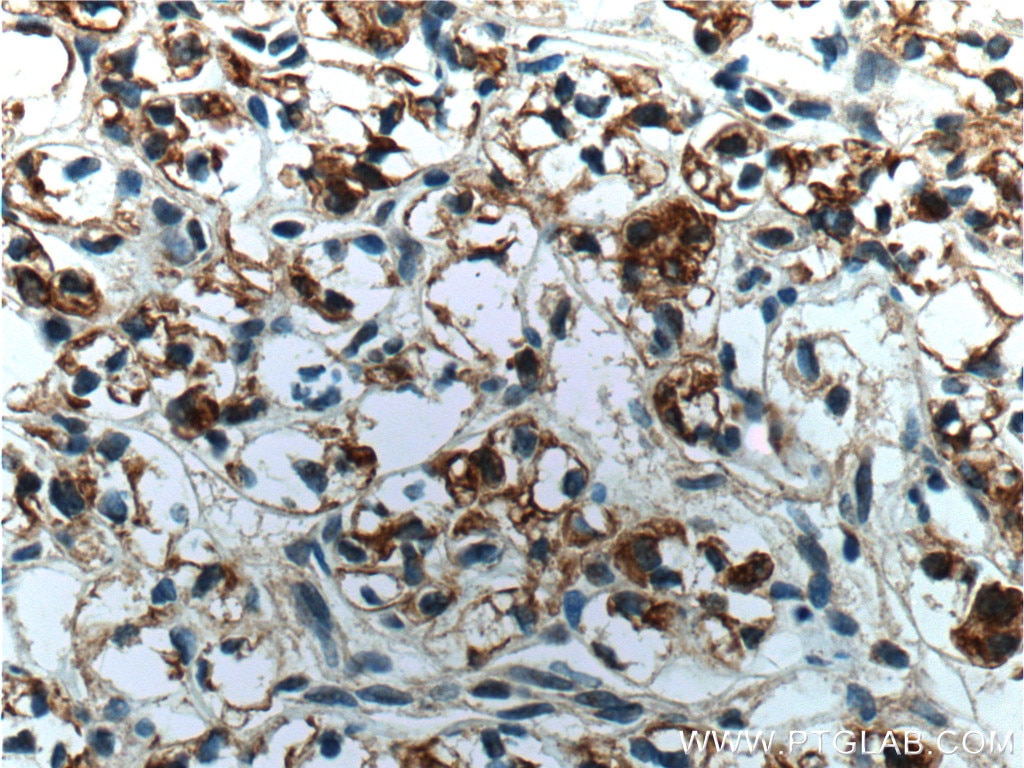 Immunohistochemistry (IHC) staining of human renal cell carcinoma tissue using Cytokeratin 18 Polyclonal antibody (10830-1-AP)