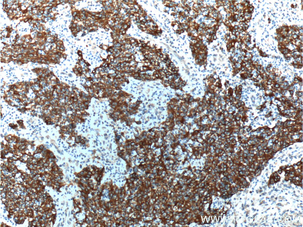 Immunohistochemistry (IHC) staining of human colon cancer tissue using Cytokeratin 18 Polyclonal antibody (10830-1-AP)