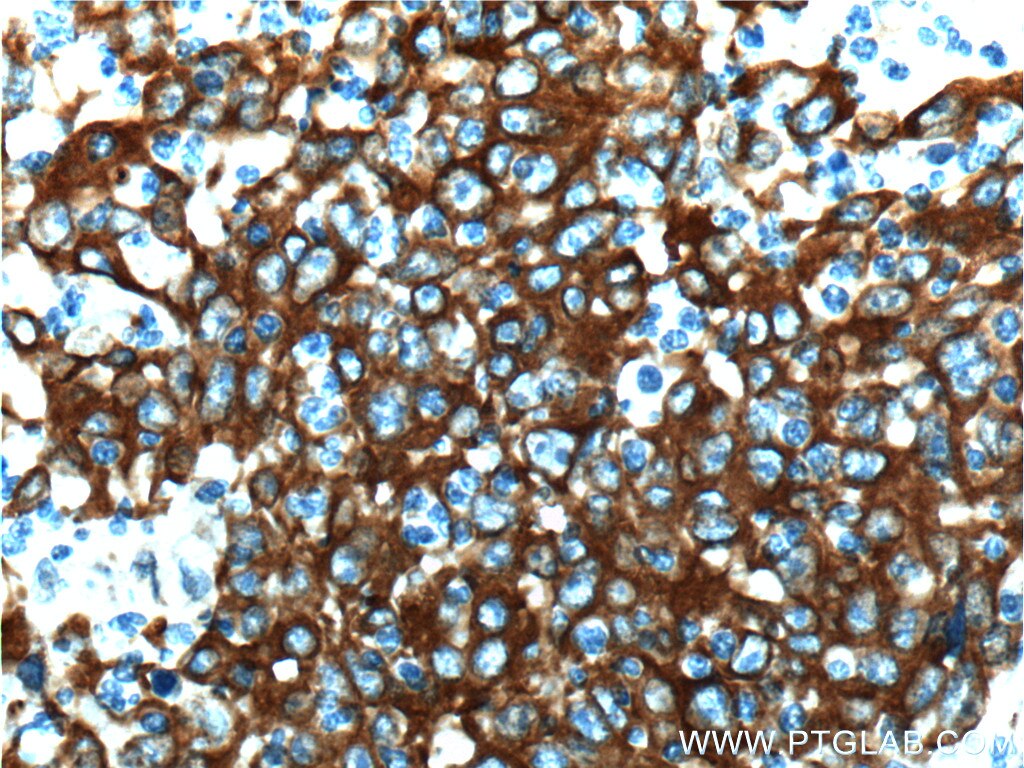 Immunohistochemistry (IHC) staining of human colon cancer tissue using Cytokeratin 18 Polyclonal antibody (10830-1-AP)