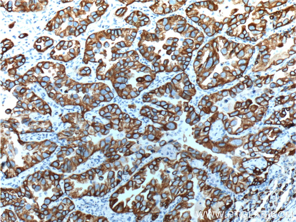 Immunohistochemistry (IHC) staining of human lung cancer tissue using Cytokeratin 18 Polyclonal antibody (10830-1-AP)