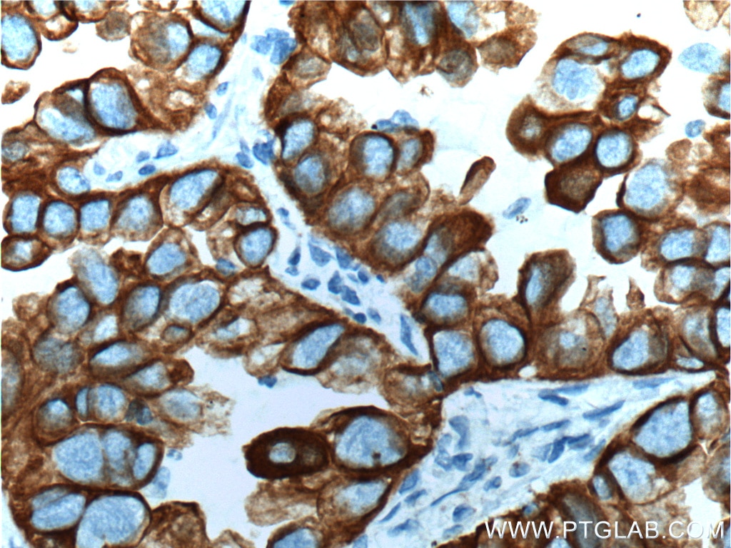Immunohistochemistry (IHC) staining of human lung cancer tissue using Cytokeratin 18 Polyclonal antibody (10830-1-AP)
