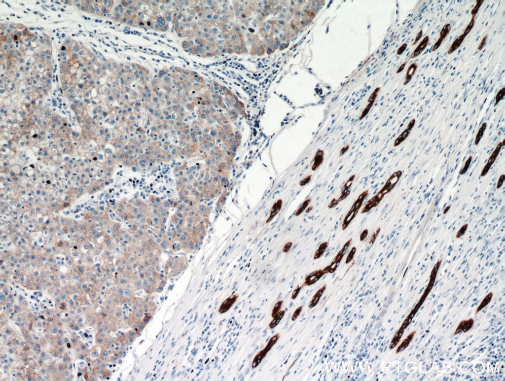 Immunohistochemistry (IHC) staining of human liver cancer tissue using Cytokeratin 18 Polyclonal antibody (10830-1-AP)