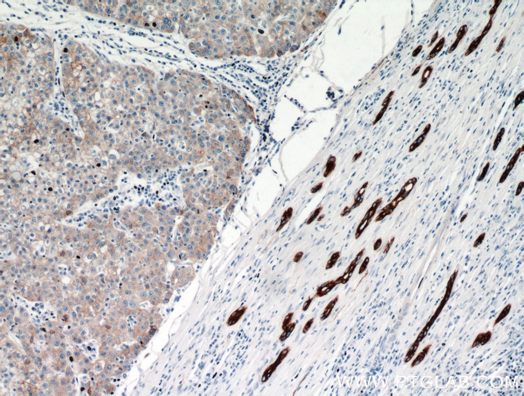 IHC staining of human liver cancer using 10830-1-AP