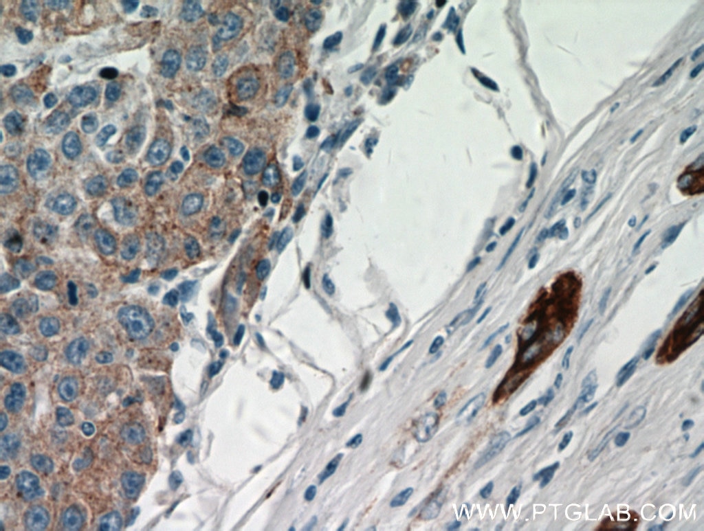 Immunohistochemistry (IHC) staining of human liver cancer tissue using Cytokeratin 18 Polyclonal antibody (10830-1-AP)