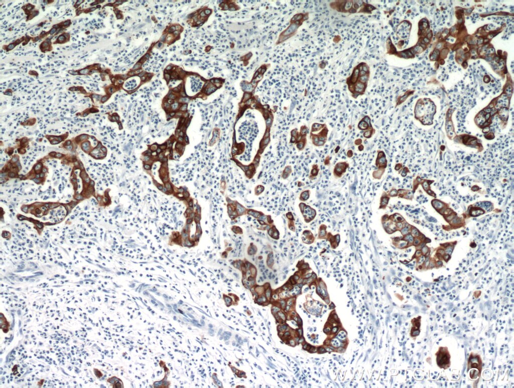 Immunohistochemistry (IHC) staining of human pancreas cancer tissue using Cytokeratin 18 Polyclonal antibody (10830-1-AP)